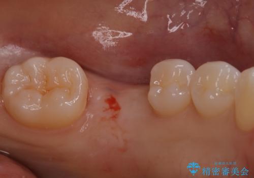 奥歯が残せないと言われた。『インプラント治療』の治療中