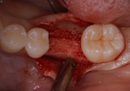奥歯が残せないと言われた。『インプラント治療』の治療中