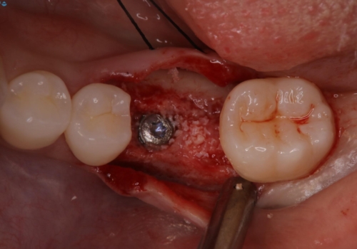 奥歯が残せないと言われた。『インプラント治療』の治療中