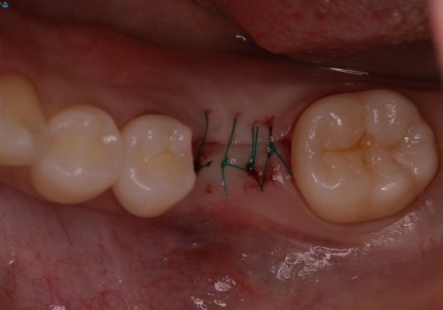 奥歯が残せないと言われた。『インプラント治療』の治療中