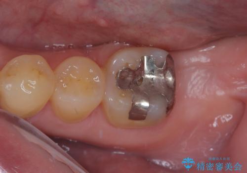 外側に飛び出している歯 部分矯正を用いた奥歯の補綴治療の治療中