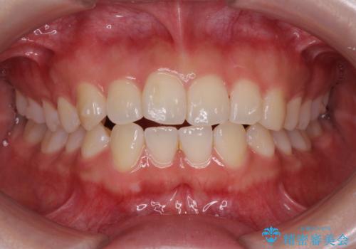 先天性の2歯欠損 個性を活かしたマウスピース矯正の治療中