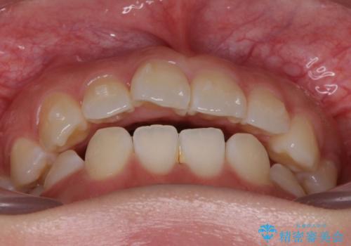 先天性の2歯欠損 個性を活かしたマウスピース矯正の治療中