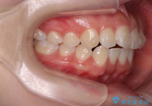 先天性の2歯欠損 個性を活かしたマウスピース矯正の治療中