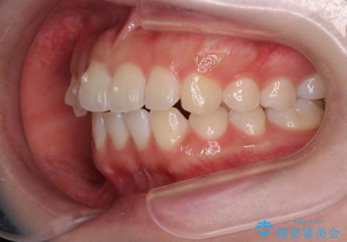 先天性の2歯欠損 個性を活かしたマウスピース矯正の治療中