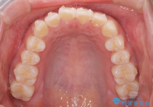 先天性の2歯欠損 個性を活かしたマウスピース矯正の治療中