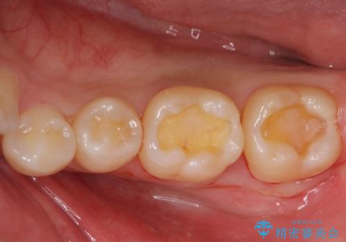 【歯に穴が空いている】ゴールドインレーで修復の治療中