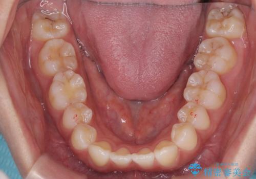 先天性の2歯欠損 個性を活かしたマウスピース矯正の治療中