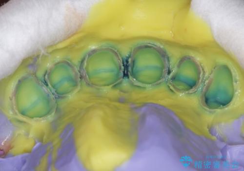 上の前歯の色味が気になる オールセラミッククラウン の治療中