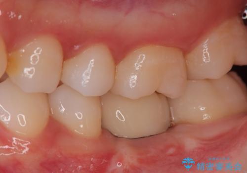 奥歯が残せないと言われた。『インプラント治療』の治療後