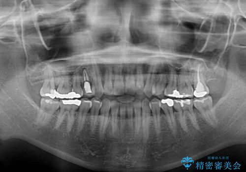 開咬をワイヤー装置で矯正治療の治療前