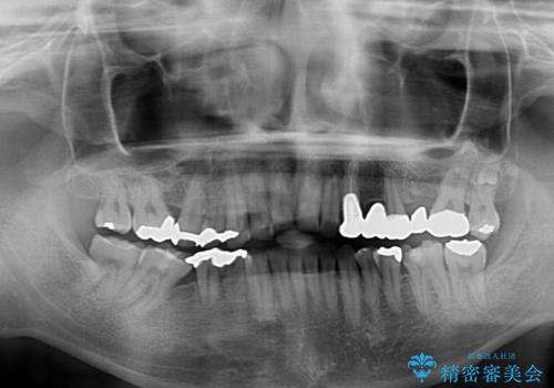 反対咬合ですり減った前歯とむし歯だらけの奥歯 総合歯科治療の治療前