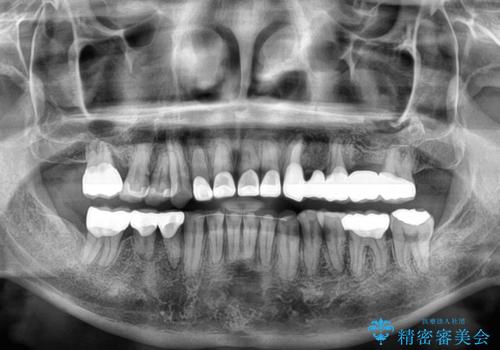 反対咬合ですり減った前歯とむし歯だらけの奥歯 総合歯科治療の治療後
