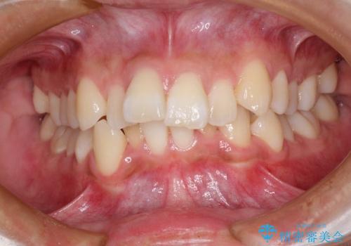 非抜歯で整える前歯の矯正の症例 治療前