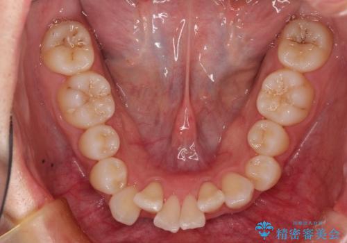 非抜歯で整える前歯の矯正の治療前