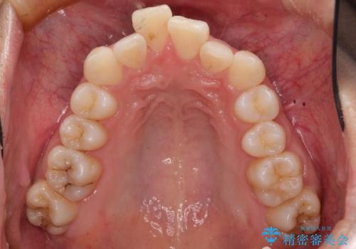非抜歯で整える前歯の矯正の治療前