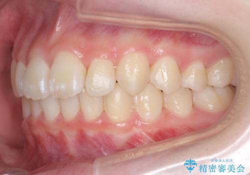 子供の出っ歯 生え代わりと成長期を利用して非抜歯で矯正の治療後