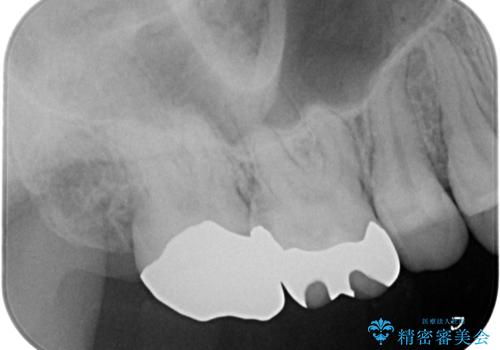 奥歯の虫歯の治療　の治療後