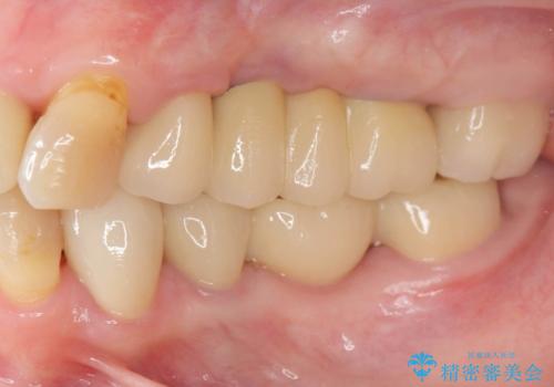 セラミック インプラント 全顎治療の治療後