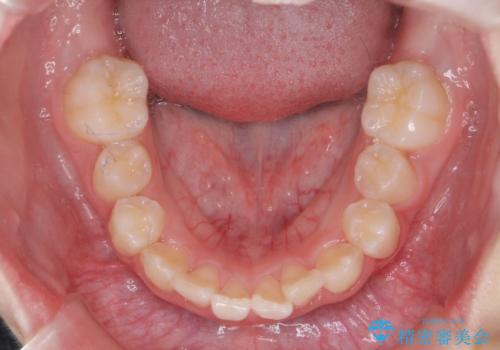 子供の出っ歯 生え代わりと成長期を利用して非抜歯で矯正の治療前