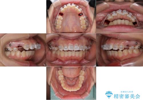 どこで噛んだらいいのかわからない:ワイヤーによる矯正治療の治療中