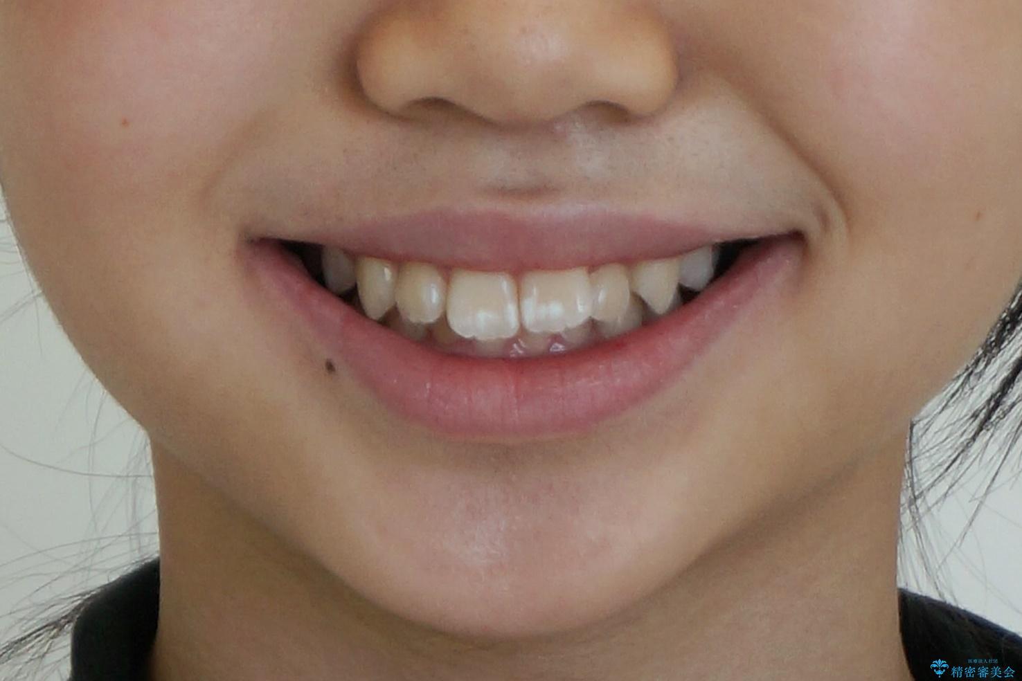 子供の出っ歯 生え代わりと成長期を利用して非抜歯で矯正の治療前(顔貌)