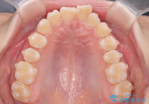 子供の出っ歯 生え代わりと成長期を利用して非抜歯で矯正の治療中