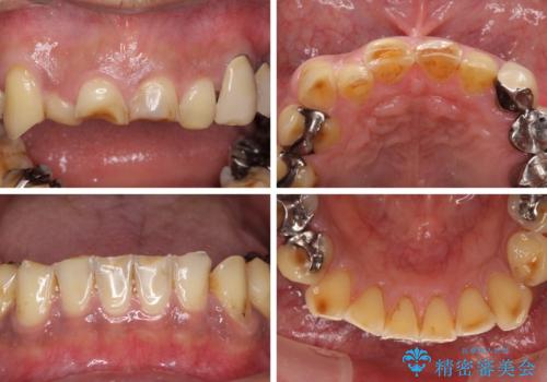 反対咬合ですり減った前歯とむし歯だらけの奥歯　総合歯科治療の治療前