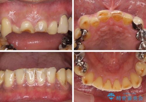 反対咬合ですり減った前歯とむし歯だらけの奥歯 総合歯科治療の治療前