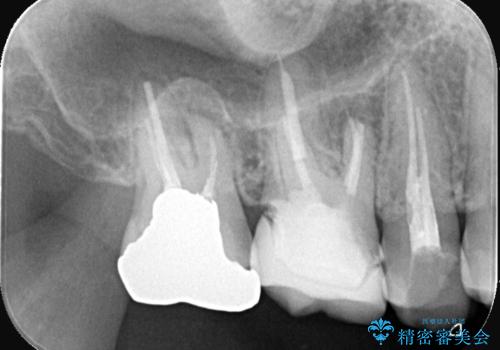 【セラミッククラウン】銀歯をオールセラミックに!の治療前