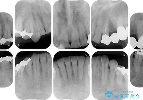 反対咬合ですり減った前歯とむし歯だらけの奥歯 総合歯科治療の治療前