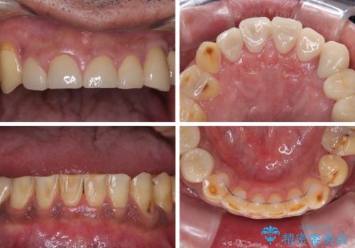 反対咬合ですり減った前歯とむし歯だらけの奥歯　総合歯科治療の治療後