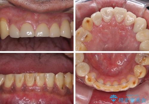 反対咬合ですり減った前歯とむし歯だらけの奥歯 総合歯科治療の治療後