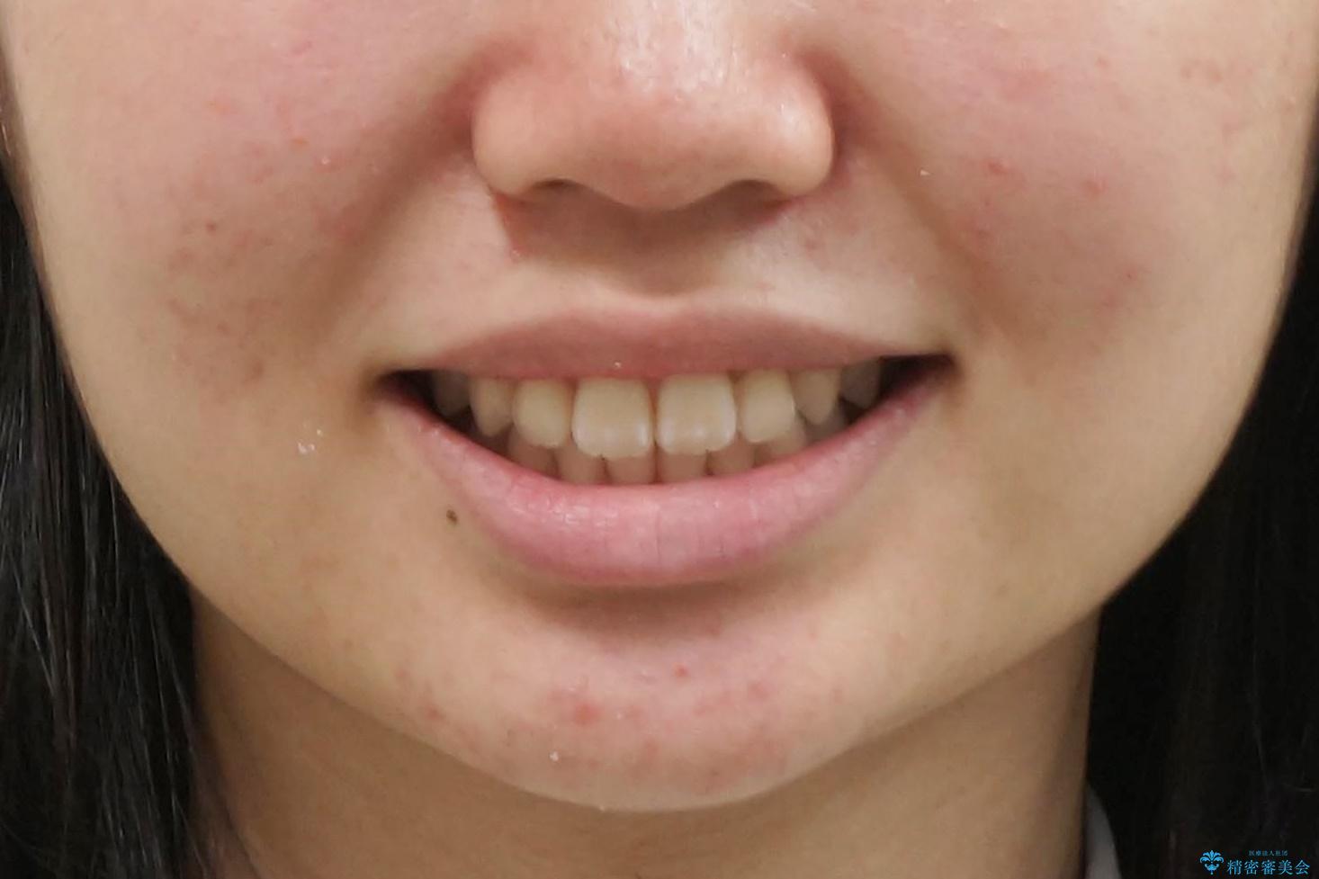 子供の出っ歯 生え代わりと成長期を利用して非抜歯で矯正の治療後(顔貌)