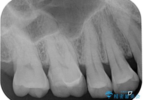 銀の詰め物が外れた　ハイブリッドアンレー修復の治療後