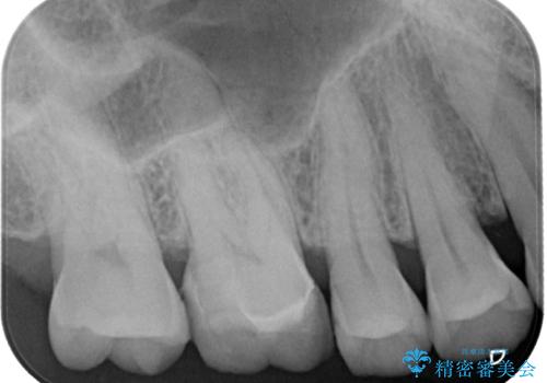 銀の詰め物が外れた ハイブリッドアンレー修復の治療後