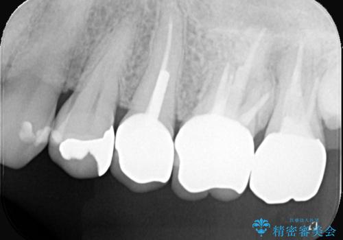 【セラミッククラウン】土台と被せものがズレている気がするの治療後