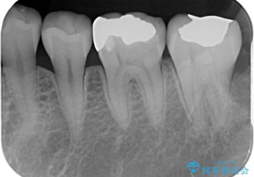 銀歯が目立つのでやり替えたい　セラミックインレー修復の治療前