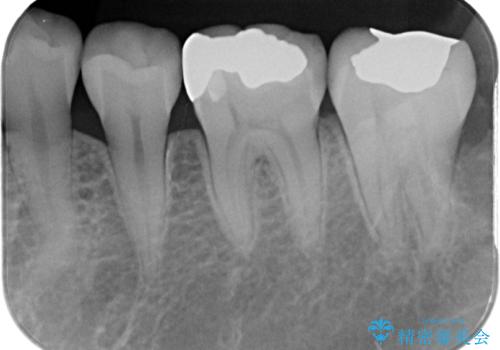 銀歯が目立つのでやり替えたい セラミックインレー修復の治療前