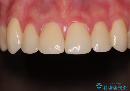 上の前歯の色味が気になる オールセラミッククラウン の症例 治療後