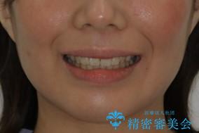 どこで噛んだらいいのかわからない:ワイヤーによる矯正治療の治療後(顔貌)