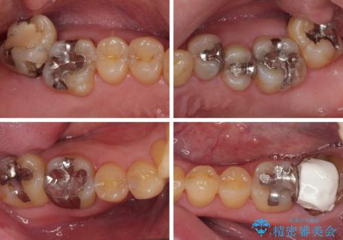 外側に飛び出している歯 部分矯正を用いた奥歯の補綴治療の治療前