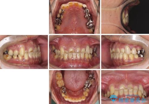 反対咬合ですり減った前歯とむし歯だらけの奥歯　総合歯科治療の治療前