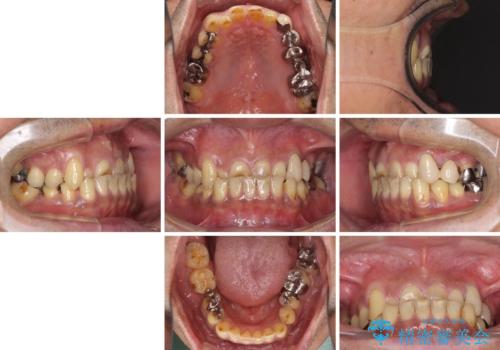 反対咬合ですり減った前歯とむし歯だらけの奥歯 総合歯科治療の治療前