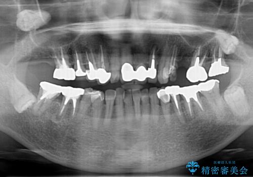 セラミック インプラント 全顎治療の治療前