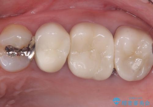 【セラミッククラウン】土台と被せものがズレている気がするの治療後