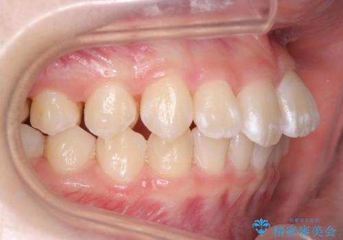 子供の出っ歯 生え代わりと成長期を利用して非抜歯で矯正の治療中