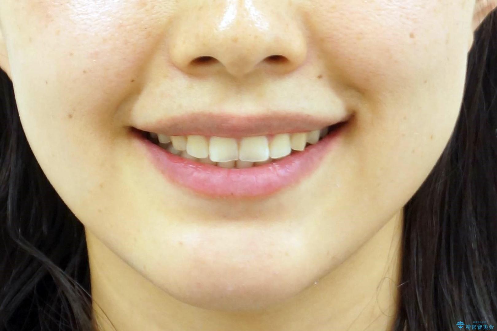 下の前歯のちょっとしたがたつきを治したいの治療後(顔貌)