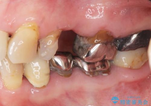 セラミック インプラント 全顎治療の治療前