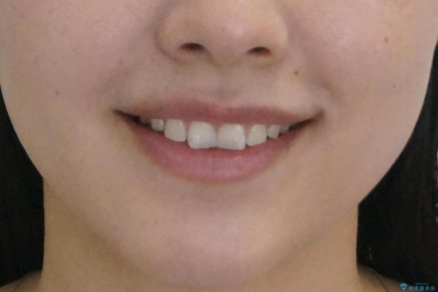 下の前歯のちょっとしたがたつきを治したいの治療前(顔貌)